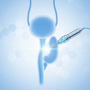 המדריך המקיף להליך כריתת ערמונית דרך השופכה (TURP)